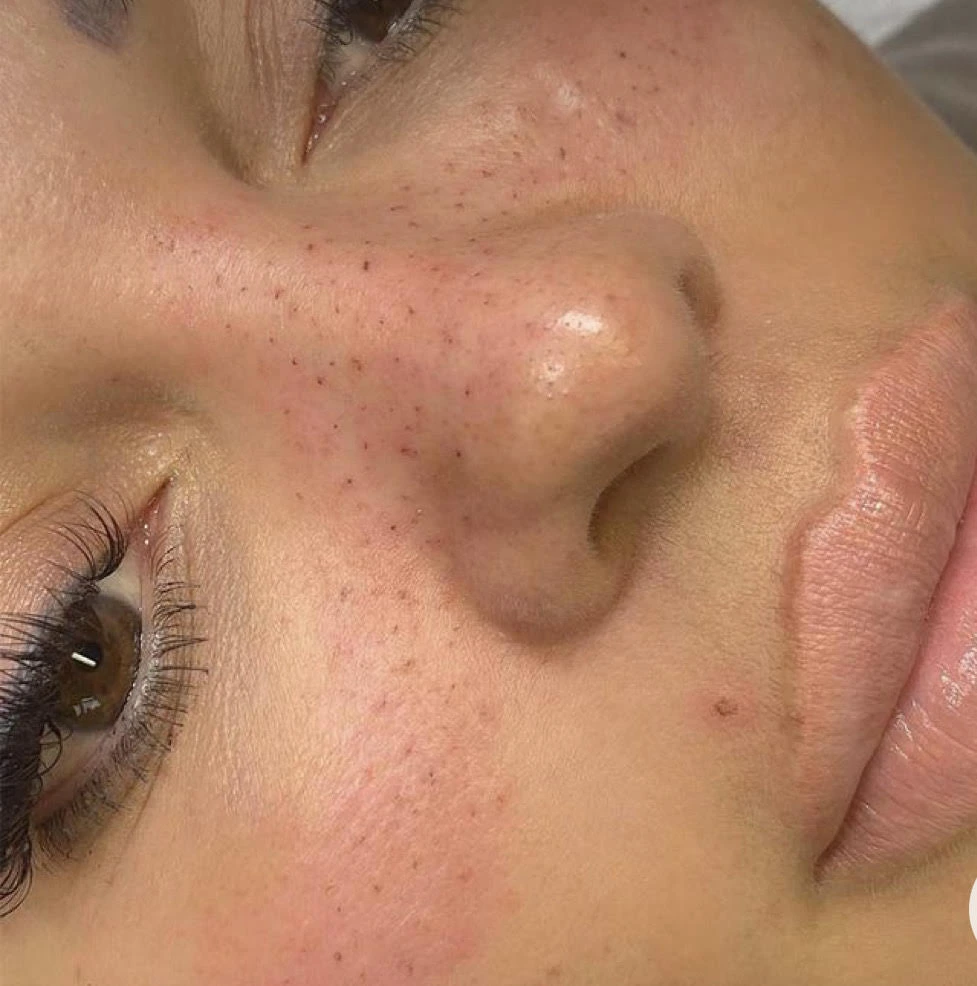 Tâche de rousseur d'une cliente à Beauty Room Dijon