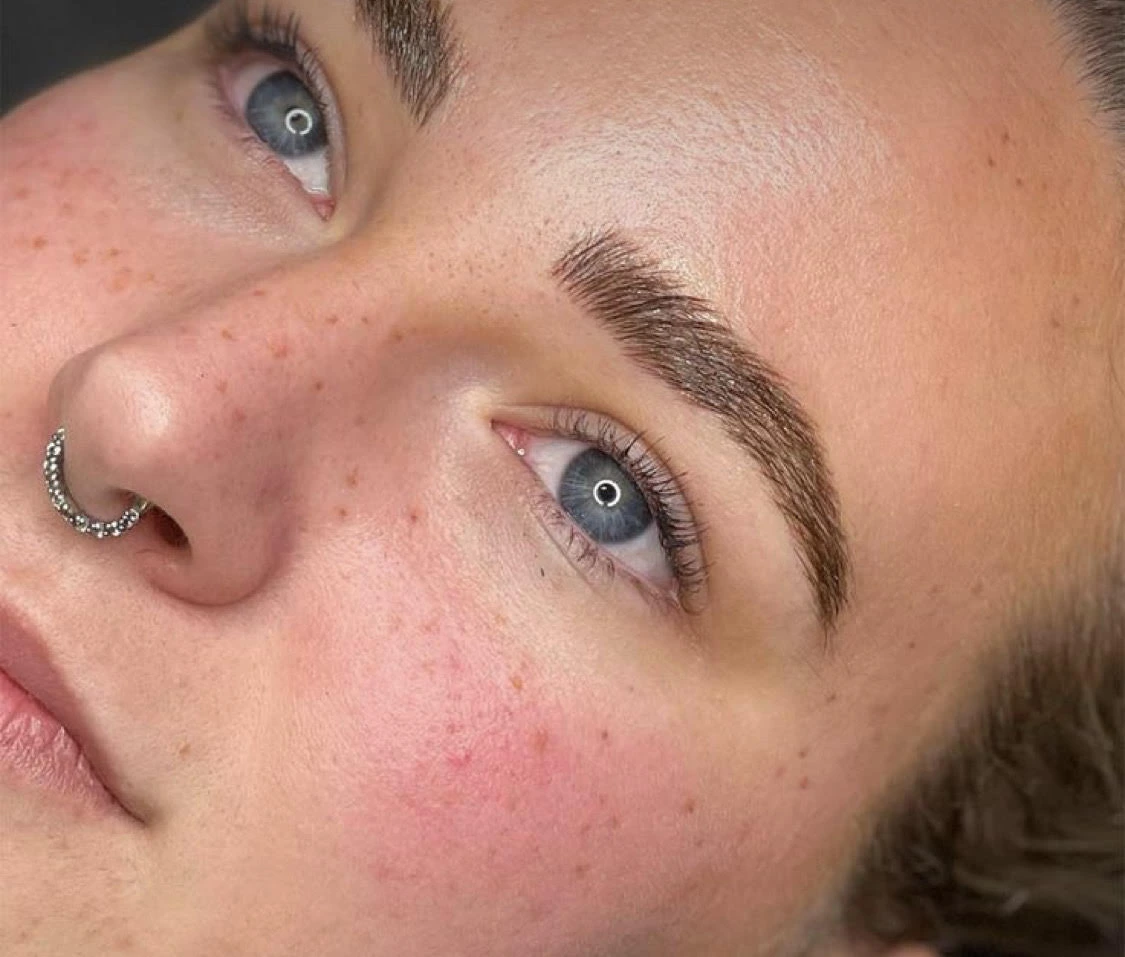 Tâche de rousseur d'une cliente à Beauty Room Dijon