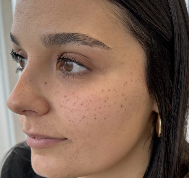 Tâche de rousseur d'une cliente à Beauty Room Dijon