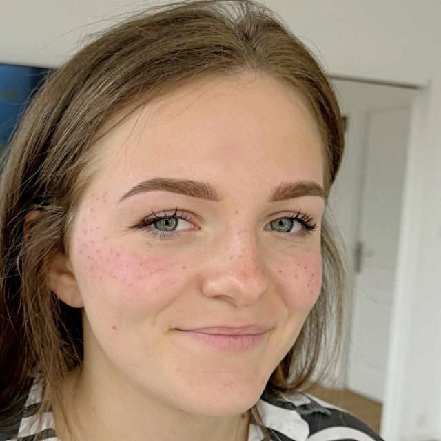 Tâche de rousseur d'une cliente à Beauty Room Dijon